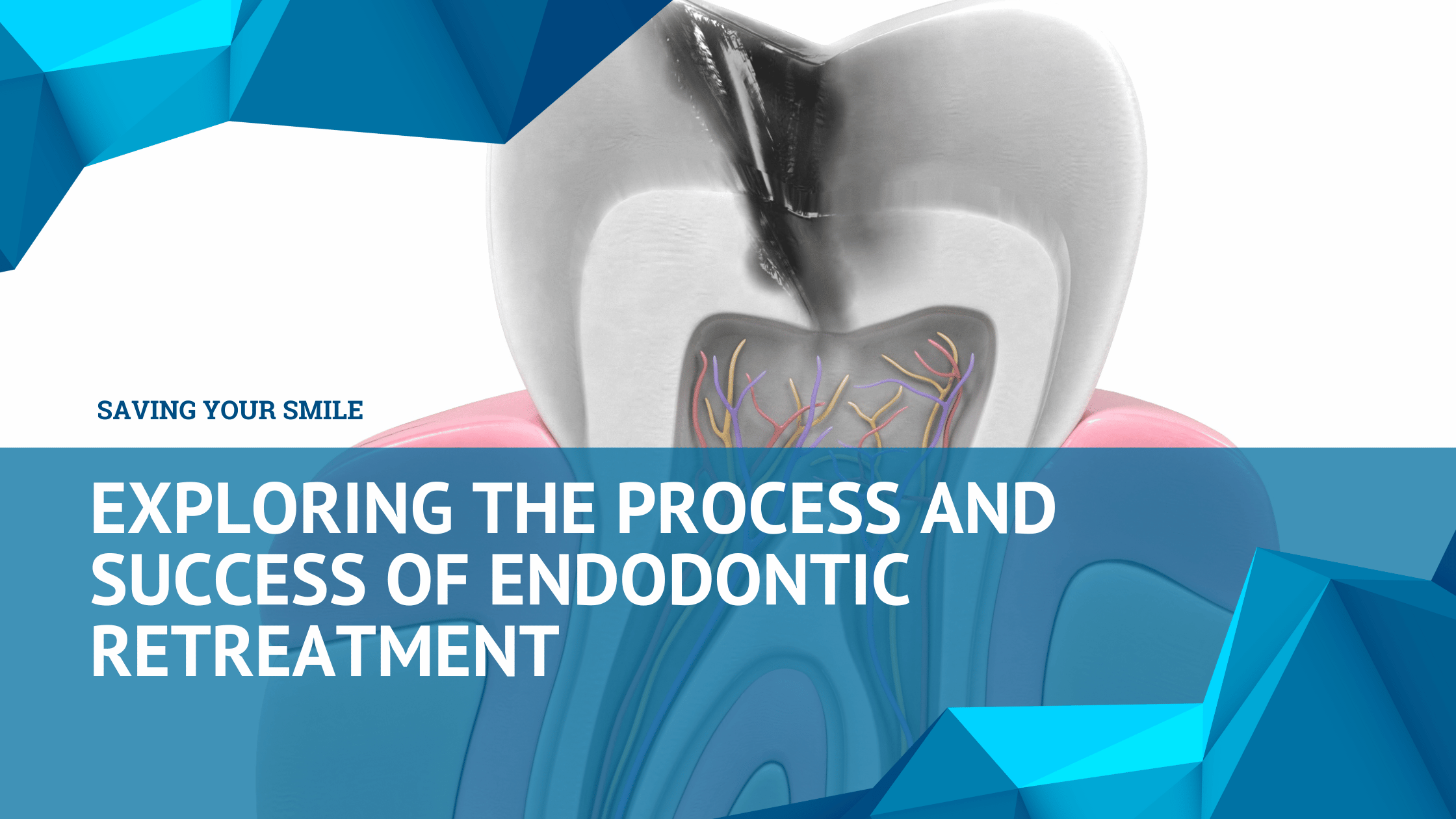Endodontic Retreatment