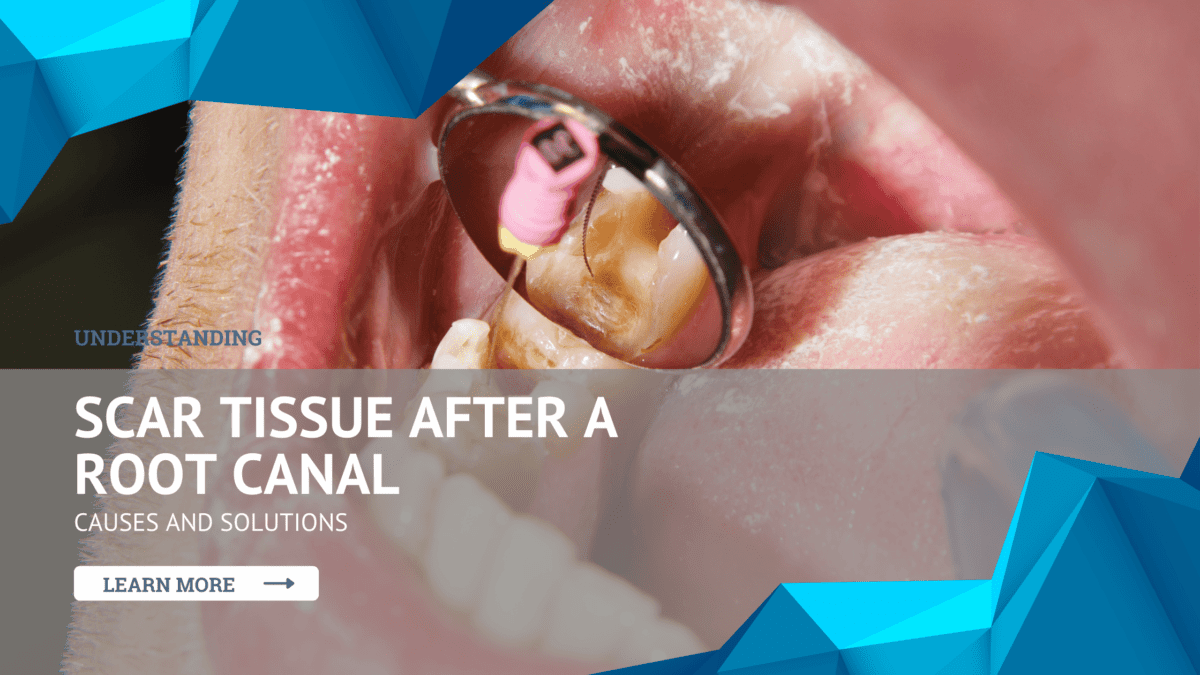 endodontic-learning-center-answers-about-root-canals