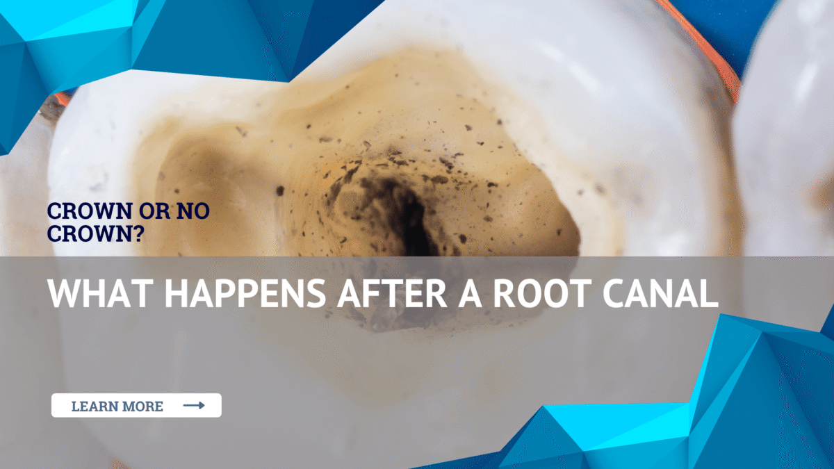 Crown or No Crown? What Happens After a Root Canal - Eastern Idaho ...
