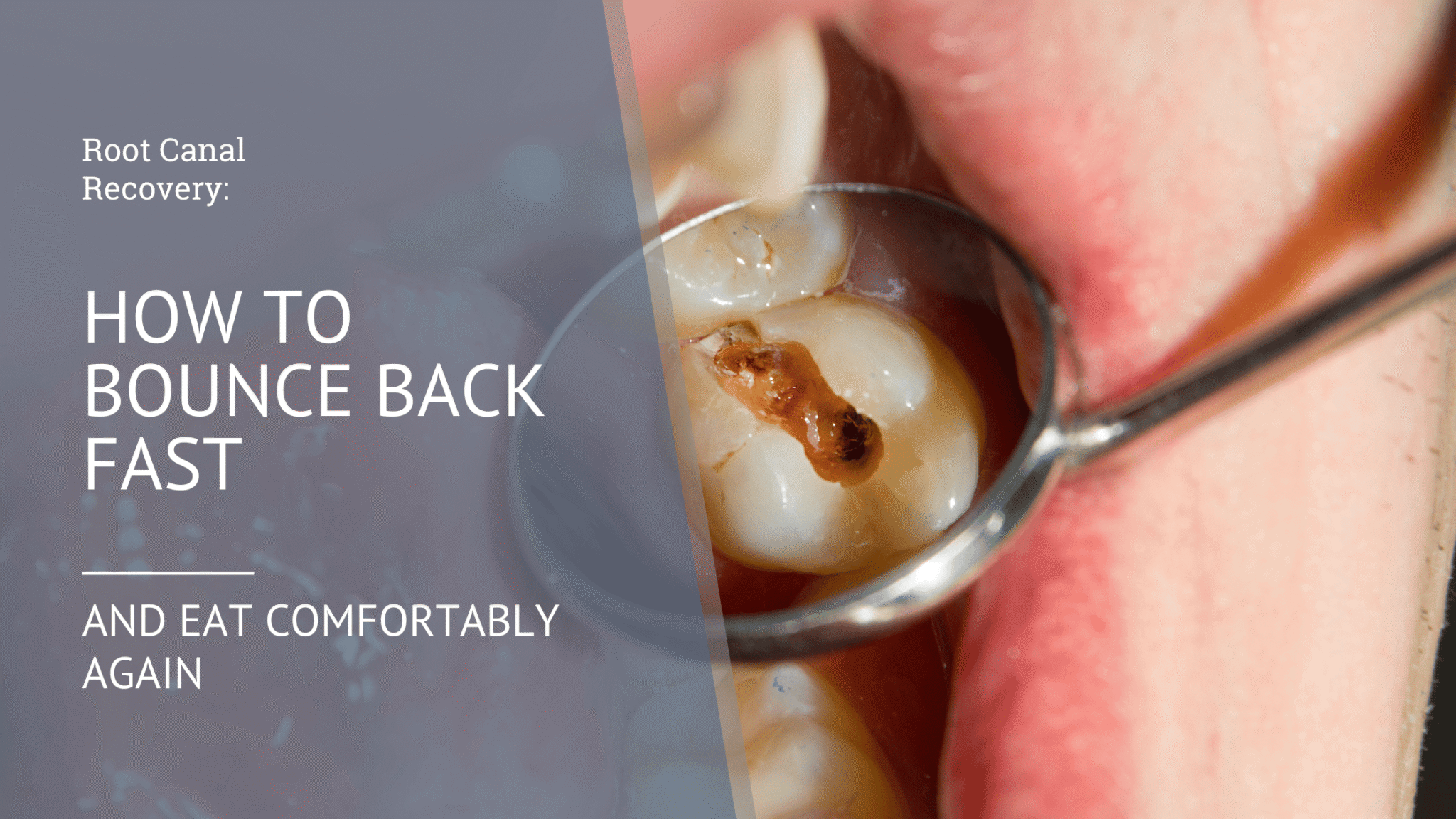 Root Canal Recovery: How to Bounce Back Fast and Eat Comfortably Again