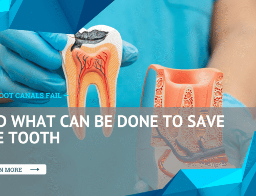 Why Root Canals Fail — And What Can Be Done to Save the Tooth