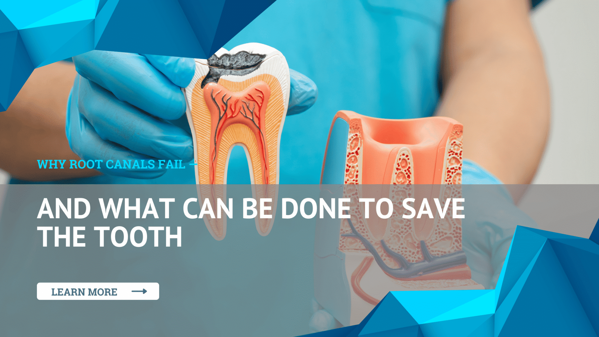 Why Root Canals Fail — And What Can Be Done to Save the Tooth