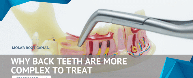 Molar Root Canal: Why Back Teeth Are More Complex to Treat