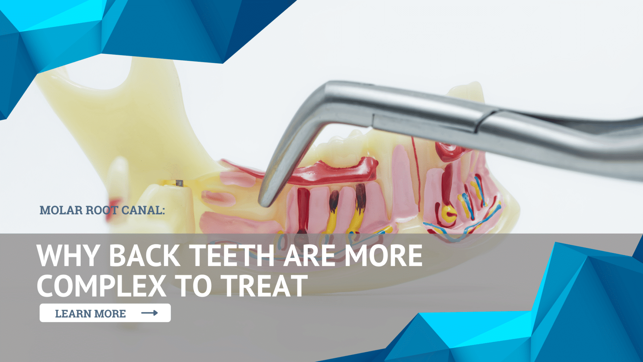 Molar Root Canal: Why Back Teeth Are More Complex to Treat
