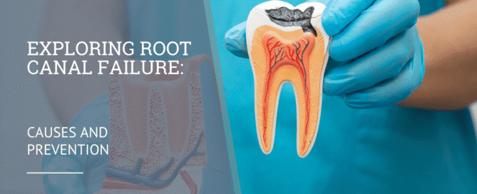 Exploring Root Canal Failure: Causes and Prevention