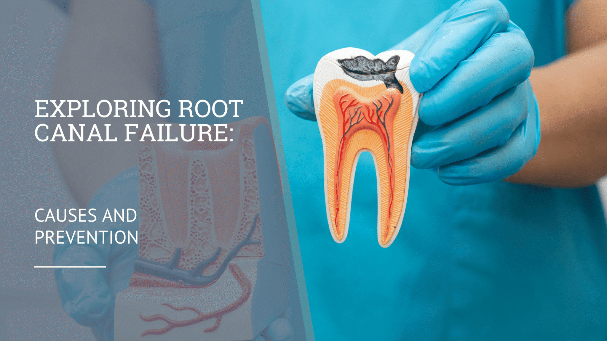 Exploring Root Canal Failure: Causes and Prevention