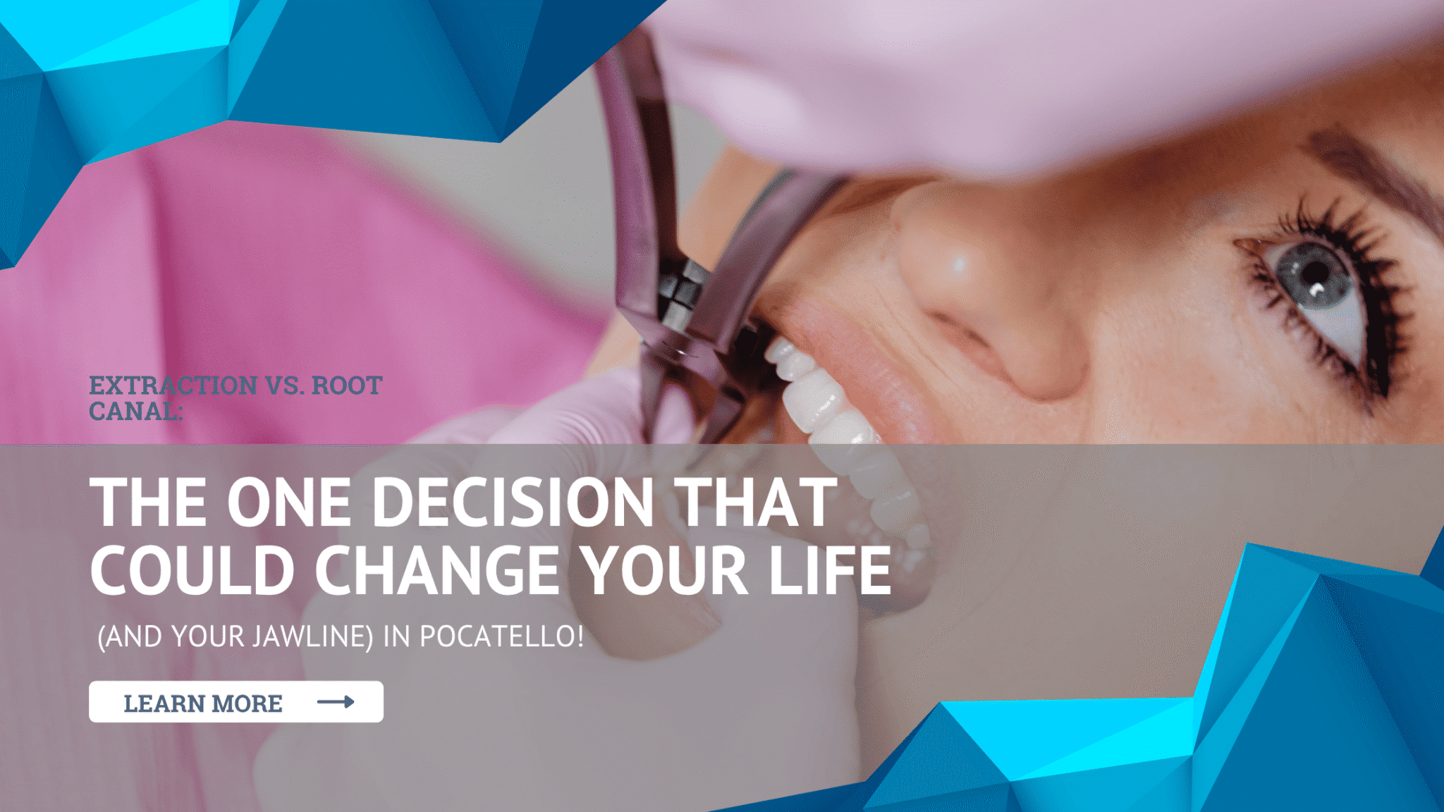 Extraction vs. Root Canal The ONE Decision That Could Change Your Life (and Your Jawline) in Pocatello!