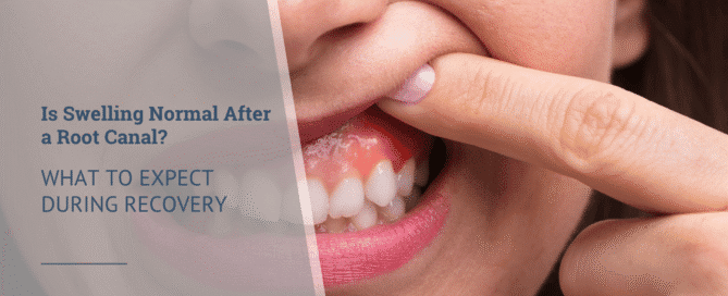 Is Swelling Normal After a Root Canal What to Expect During Recovery