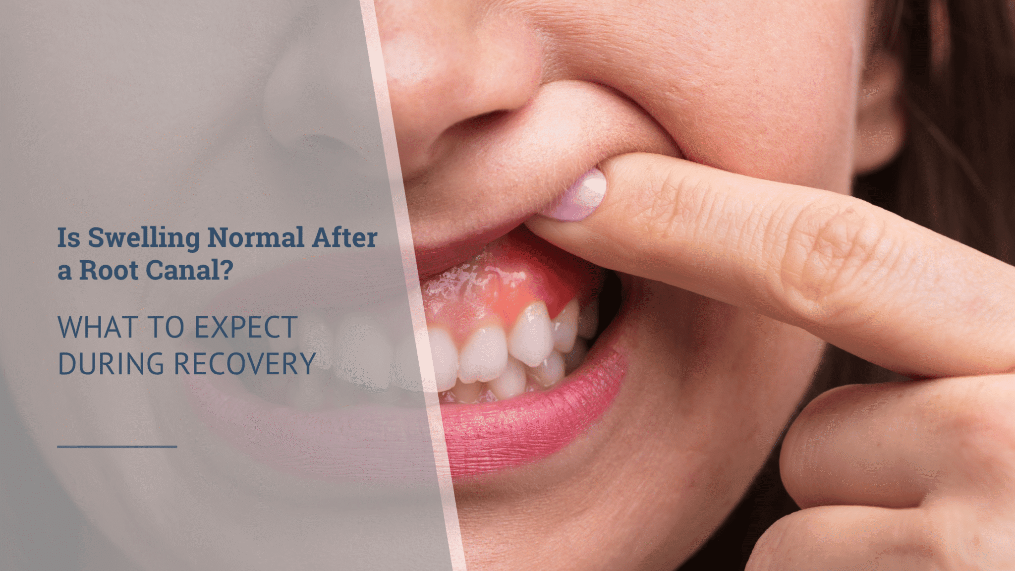 Is Swelling Normal After a Root Canal What to Expect During Recovery