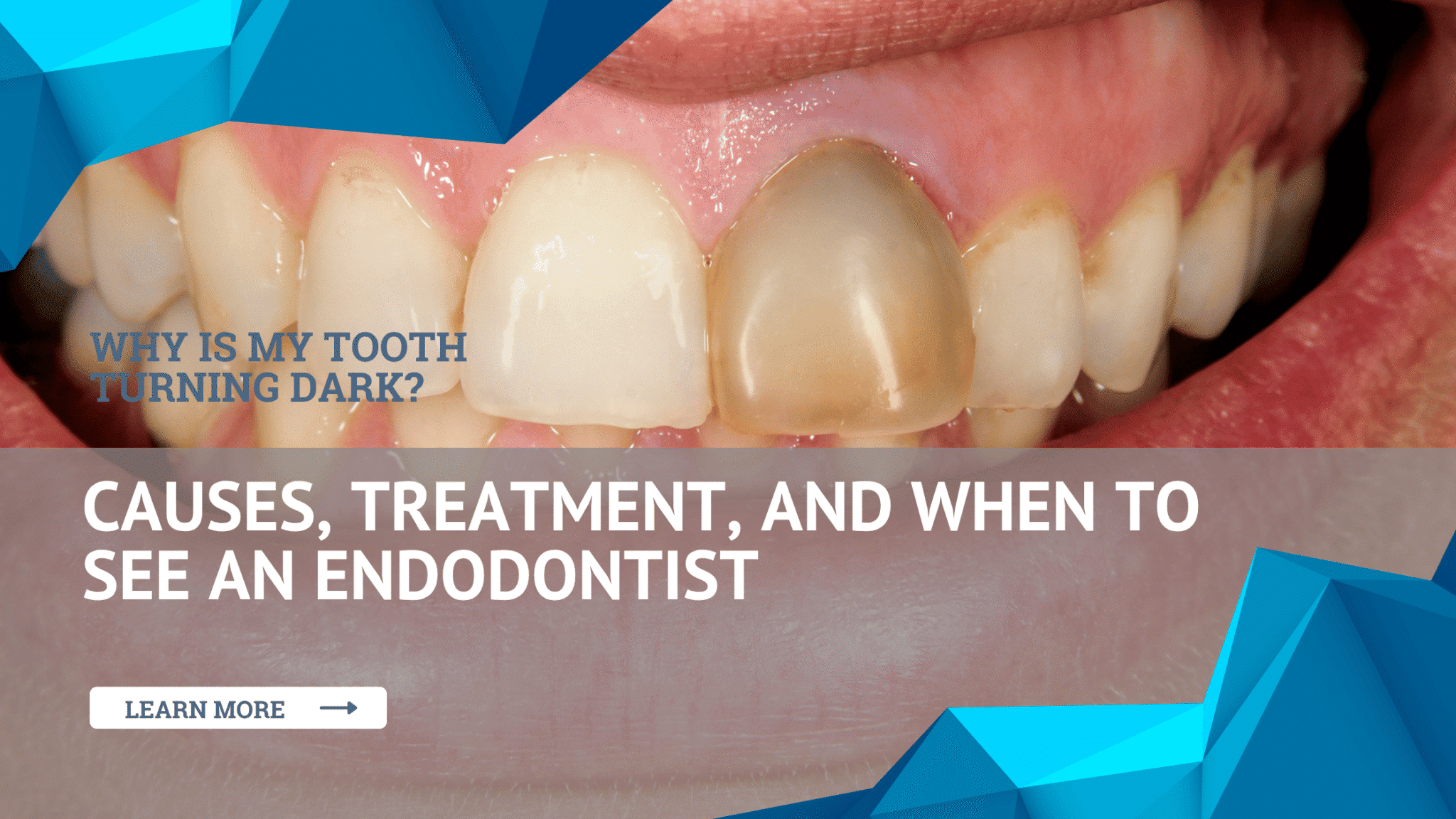 Why Is My Tooth Turning Dark?
