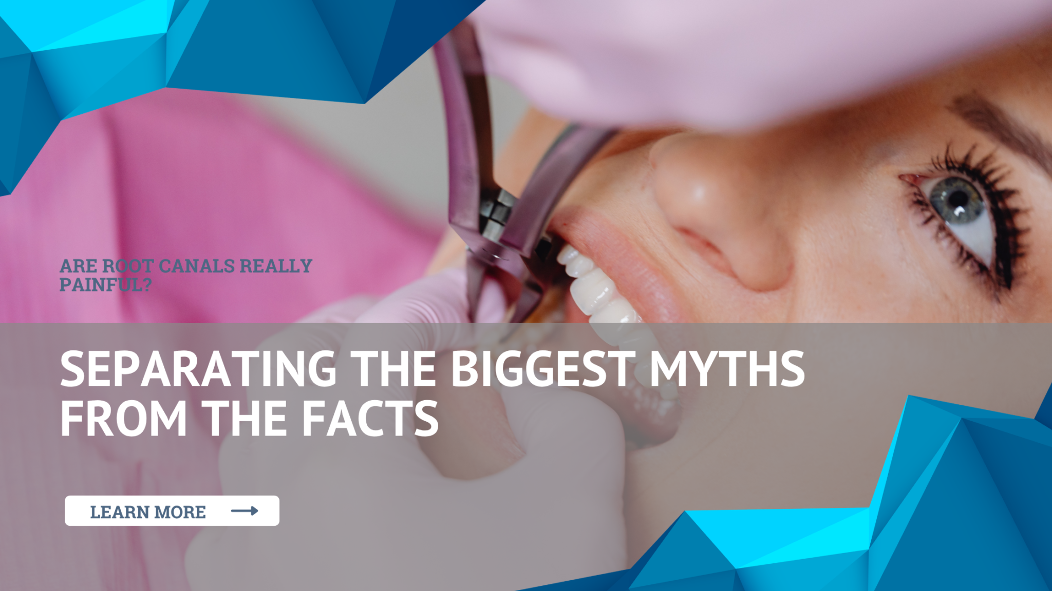Are Root Canals Really Painful Separating the Biggest Myths from the Facts