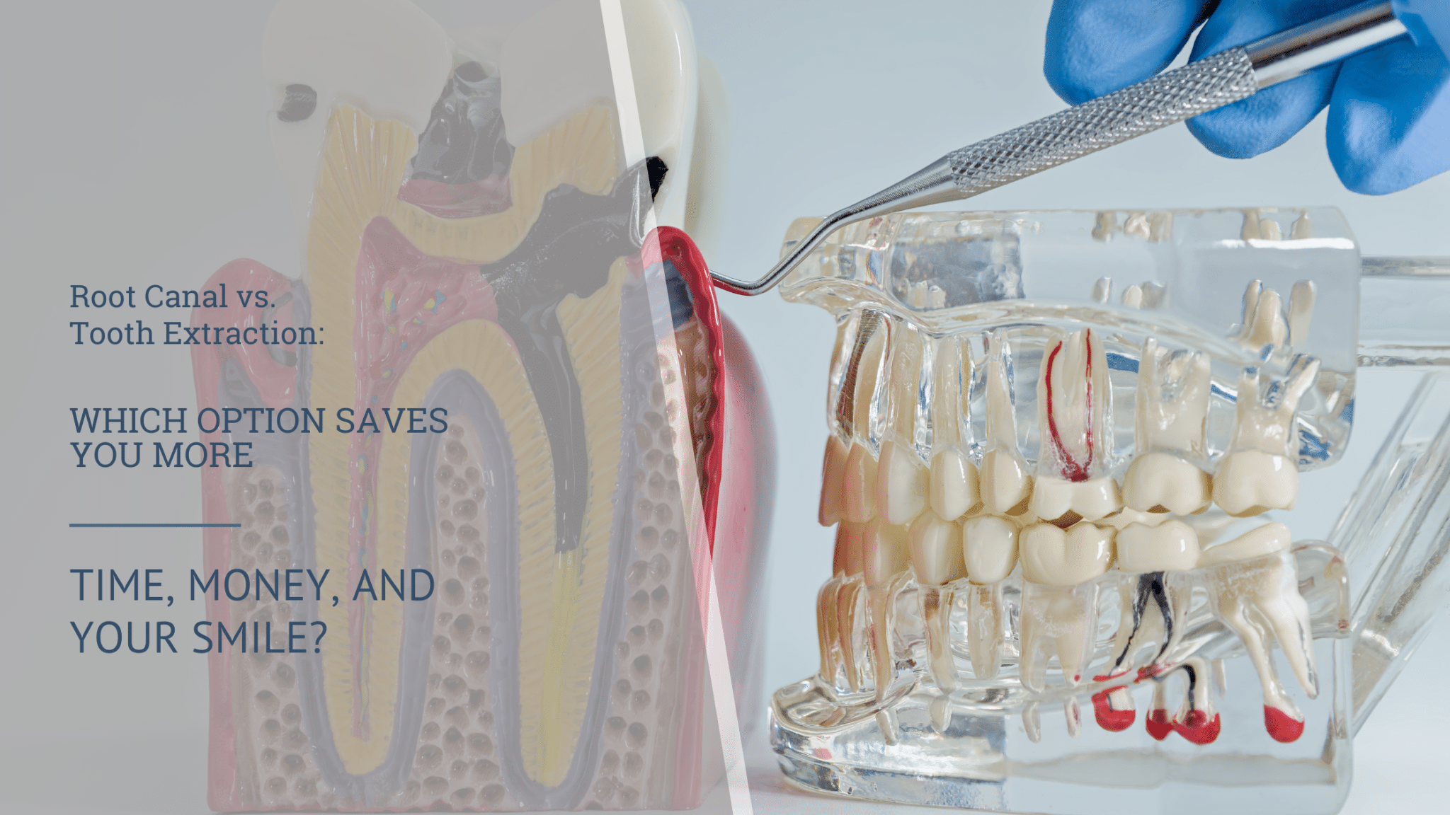 Root Canal vs. Tooth Extraction Which Option Saves You More Time, Money, and Your Smile