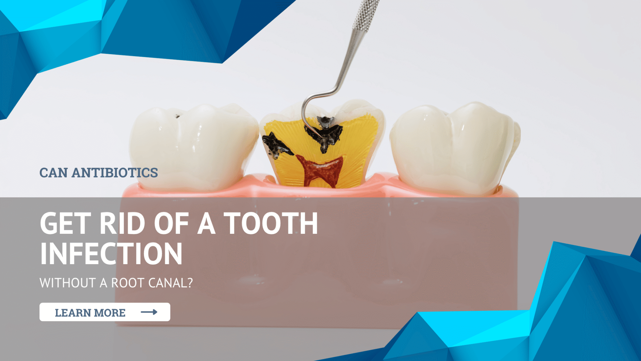 Can Antibiotics Get Rid of a Tooth Infection Without a Root Canal