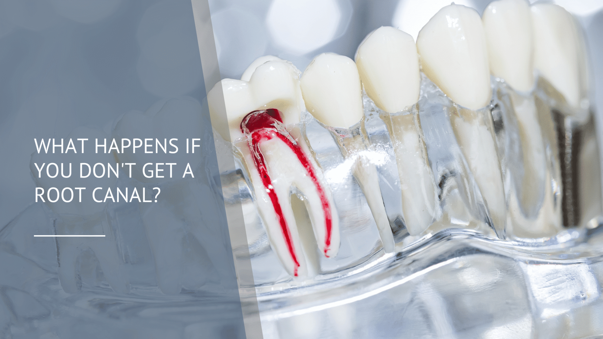 What Happens If You Don't Get a Root Canal