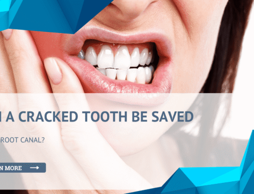Can a Cracked Tooth Be Saved With a Root Canal?