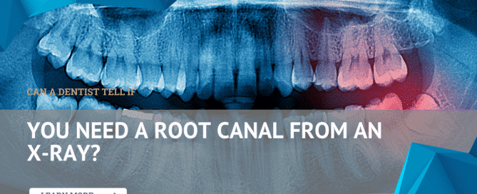 Dental X-ray used to determine if a tooth needs a root canal