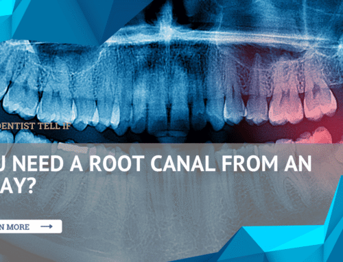 Can a Dentist Tell If You Need a Root Canal From an X-Ray?