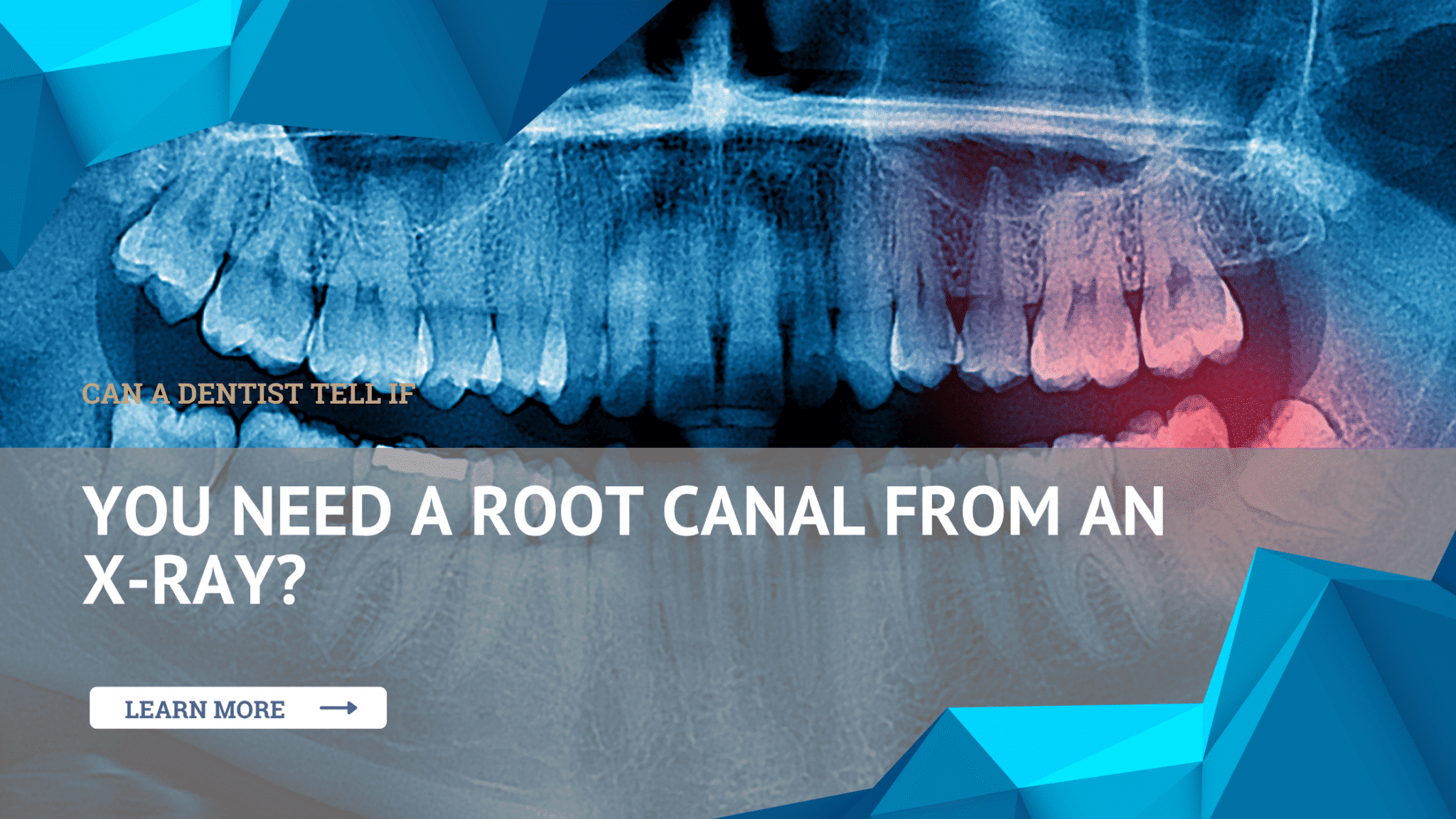 Dental X-ray used to determine if a tooth needs a root canal